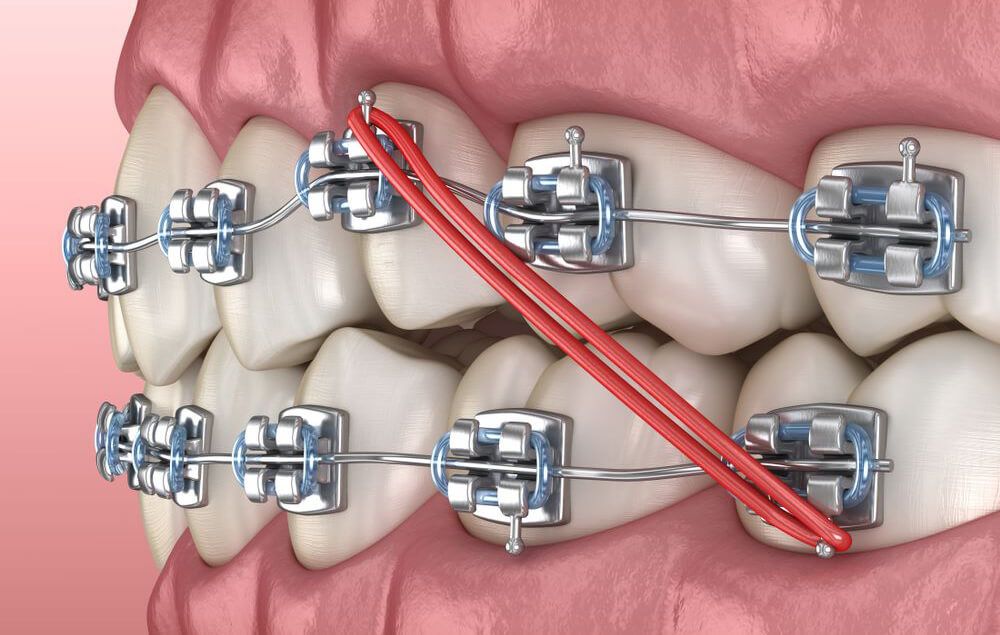 niềng răng bị móm bao nhiêu tiền